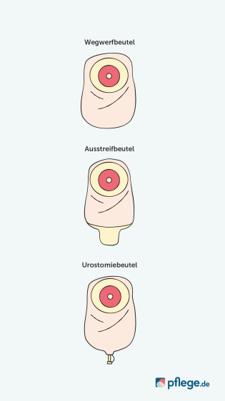 Stoma-Versorgung