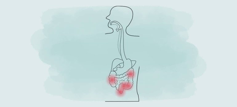 Colitis ulcerosa