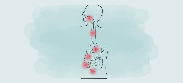 Morbus Crohn