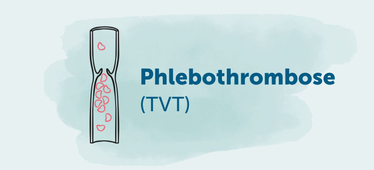 Phlebothrombose TVT