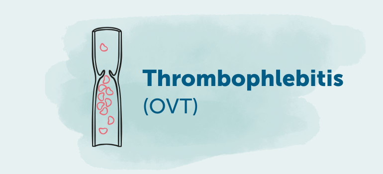 Thrombophlebitis oberflächliche Venenthrombose (OVT)