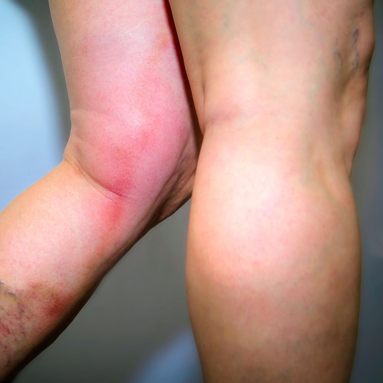 Thrombose in der Kniekehle