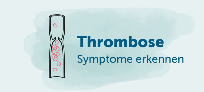 Thrombose-Symptome erkennen